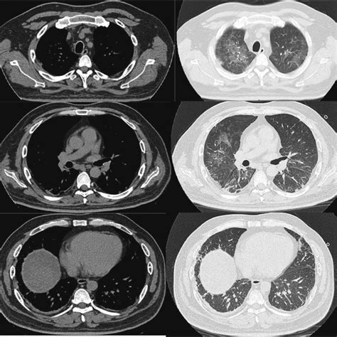 The Lung Ct Showing Patchy Ground Glass Infiltrate Most Marked In The