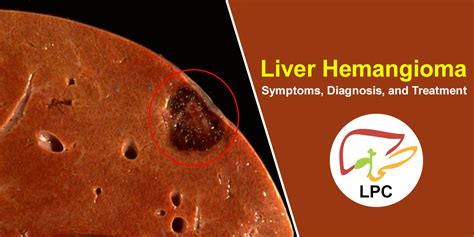 Liver Hemangioma Symptoms Diagnosis And Treatment