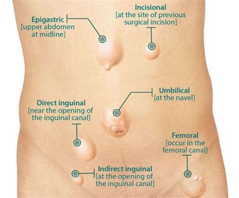 In female fetuses, the ovaries or bowel tissue can spill through the opening and cause a hernia. Direct Versus Indirect Inguinal Hernia - Holistic Hernia Remediation