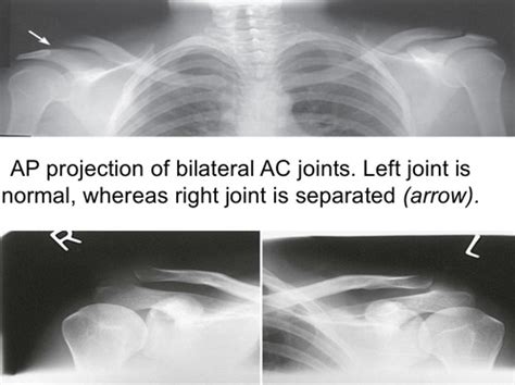 Ch 6 Clavicle Scapula And Ac Joints Flashcards Quizlet