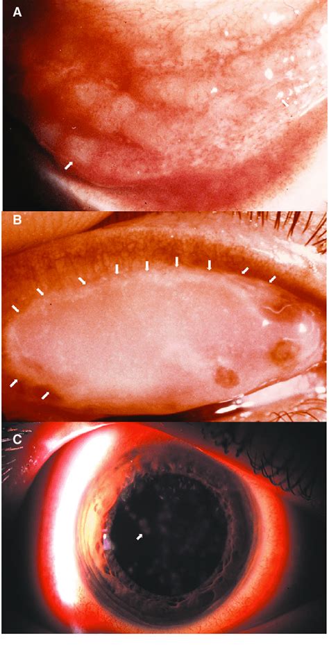 Photomicrographs Of Common Clinical Manifestations Of Ocular Surface In