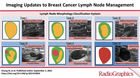 Imaging Updates To Breast Cancer Lymph Node Management Radiographics