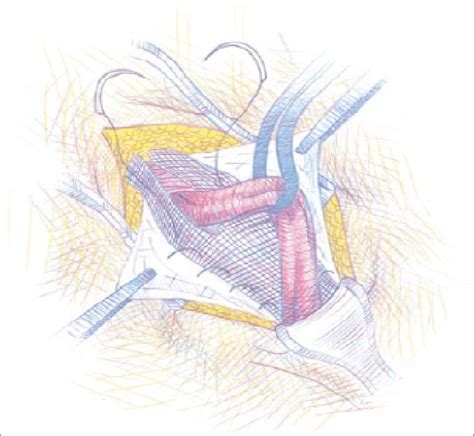 Inguinal Hernioplasty Surgery Using The Lichtenstein Technique Showing