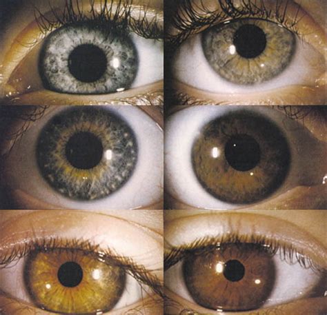 Heterochromia After Pediatric Cataract Surgery Journal Of American