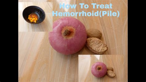 How To Effectively Treat Hemorrhoidpilenatural Way To Treat