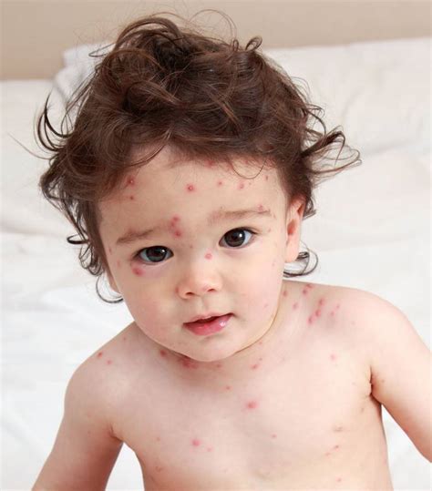 Bei der immunisierung werden komplexe schutzmechanismen aktiviert, mit denen das körpereigene immunsystem krankheitserreger abwehrt. Nachholbedarf bei Windpocken - MAINLIKE®
