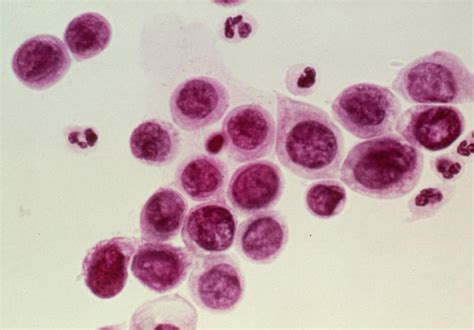 Lm Of Cervical Smear Showing Severe Dysplasia Photograph By Science