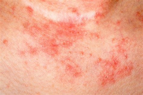Eczema Facts Things You Need To Know The Healthy