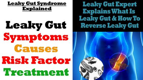 Leaky Gut Syndrome Causes Symptoms Risk Factors And How To Reverse