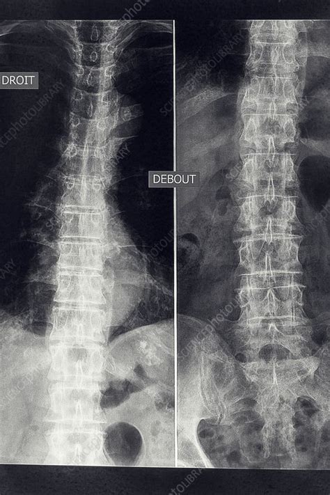 Osteoarthritis Of The Lumber Spine X Ray Stock Image C0368214