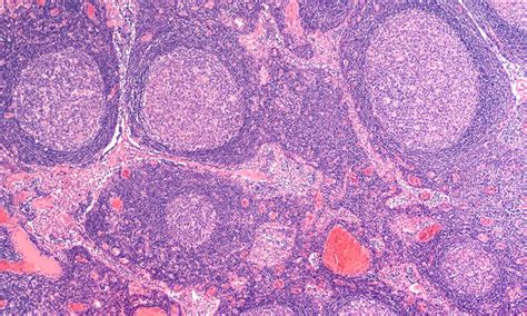 Lymph Node Metastases May Not Always Be Source Of Cancers Spread