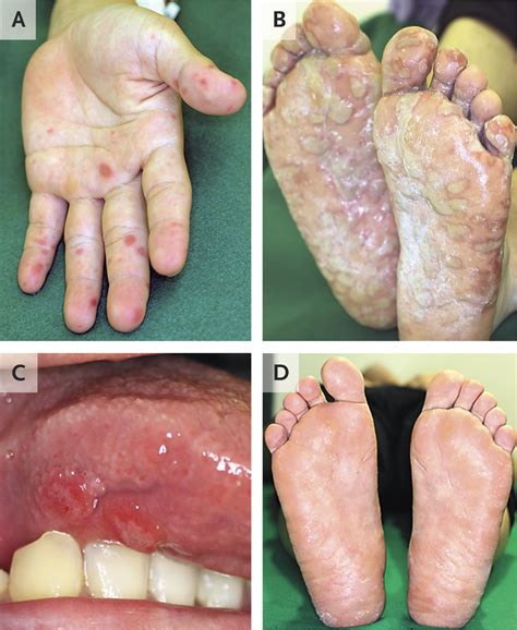 Hand Foot And Mouth Disease In Mouth