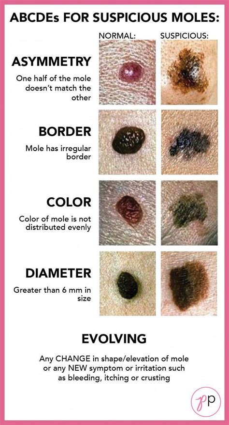 Get Rid Of Blackheads Pimples Cancerous Moles Healthy Life Hacks Stress And Health Mental
