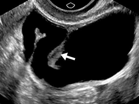 Evaluating Fallopian Tube Patency What The Radiologist Needs To Know