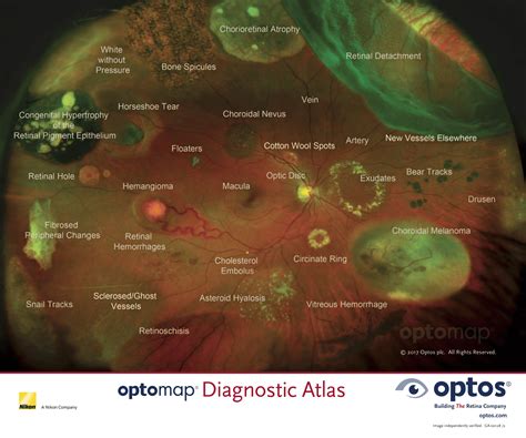 Optomap Digital Retinal Imaging A New Standard Of Eye Care Premier