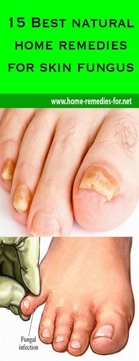 15 Best Natural Home Remedies For Skin Fungus Home Remedies For Skin