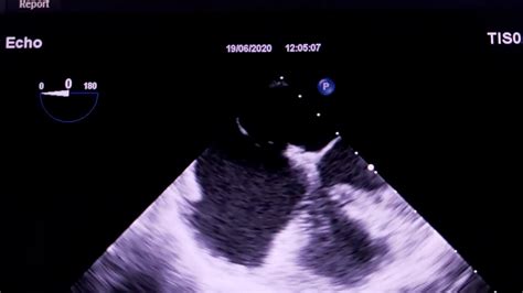 Echocardiogram Atrial Septal Defect Asd Youtube