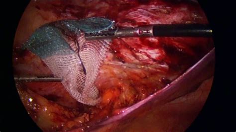 An incisional hernia is a bulge of peritoneal contents through a fascial defect in the abdominal wall world society of emergency surgery (wses) uses grading of recommendations, assessment. LAPAROSCOPIC PRE-PERITONEAL REPAIR OF SUBXIPHOID INCISIONAL HERNIA - YouTube