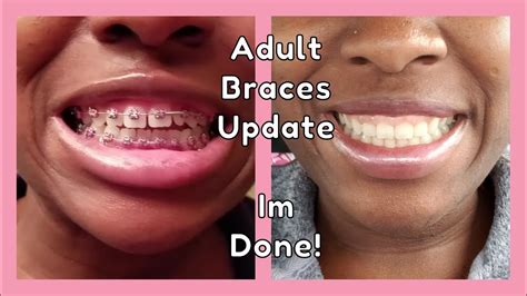 My Adult Braces Journey Is Over The Results Youtube