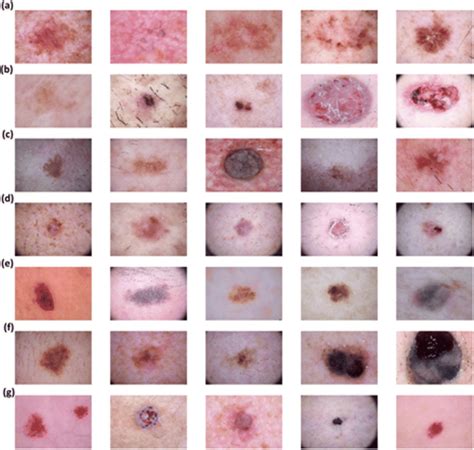 Skin Cancer Examples