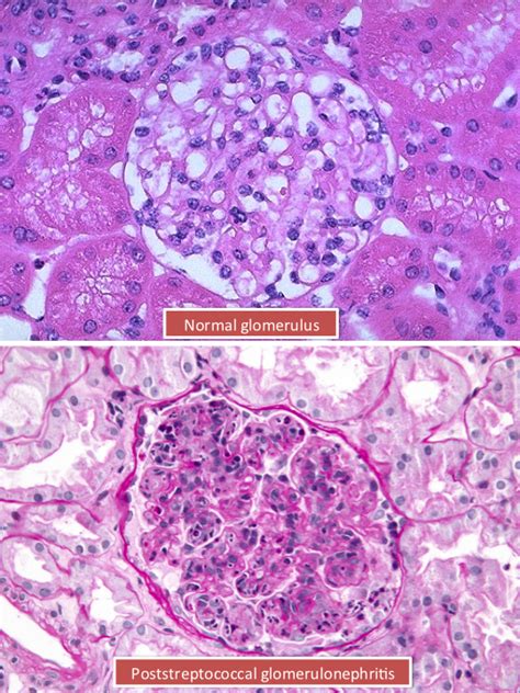 Post Sterptococcal Glomerulonephritis Is A Common Complication Of Group A Streptococcal