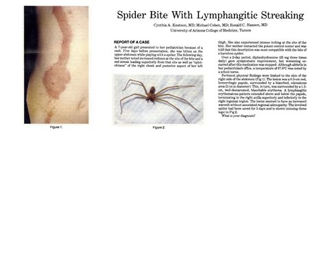 Jama Network Jama Dermatology Spider Bite With Lymphangitic Streaking