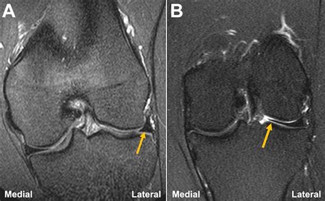 The Relationship Between Discoid Meniscus And Articular Cartilage