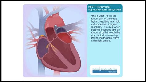 Learn about atrioventricular nodal reentry (reentrant) tachycardia (avnrt), with emphasis on ecg, clinical features, physiology, management and prognosis. PSVT (Paroxysmal Supraventricular Tachycardia) Animation ...