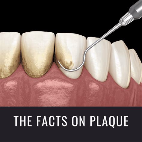 The Facts On Plaque Cromwell Dentists Fedorciw Massoumi And Kolbig