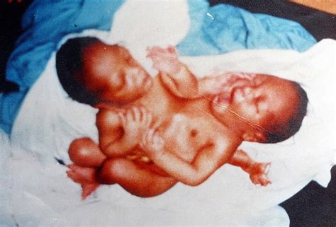 The First Conjoined Twins To Be Separated In The Uk Reveal They Share A