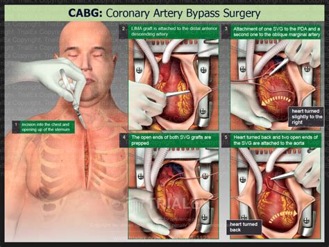 Cabg Coronary Artery Bypass Surgery Trial Exhibits Inc
