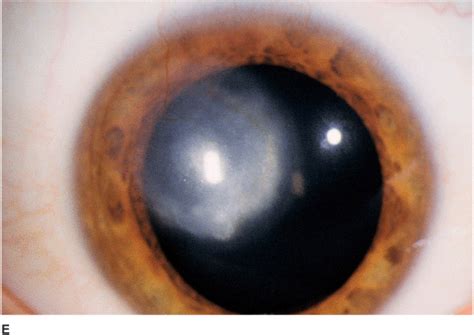 By ellen stodola eyeworld senior staff writer. Corneal Infections, Inflammations, and Surface Disorders ...