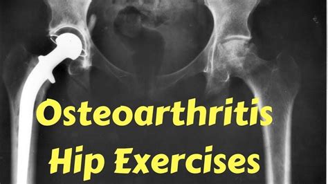 Osteoarthritis Hip Exercises Osteoarthritis Hip Rheumatoid Arthritis