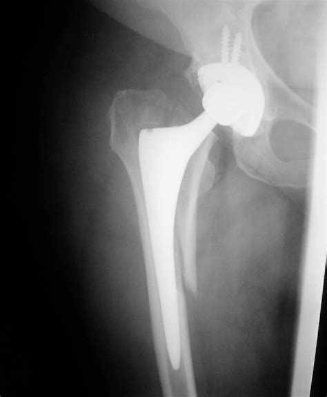 Figure 2 From Total Hip Arthroplasty Periprosthetic Femoral Fractures