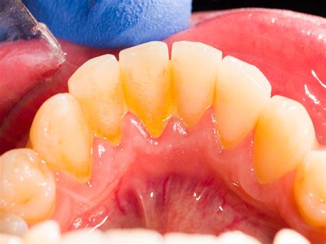 Tooth Plaque Causes Prevention And Treatment