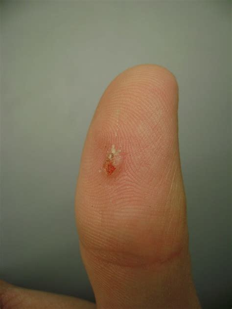 These warts have a rough texture and may have a black dot that looks like a seed. fingertip wart pictures - pictures, photos
