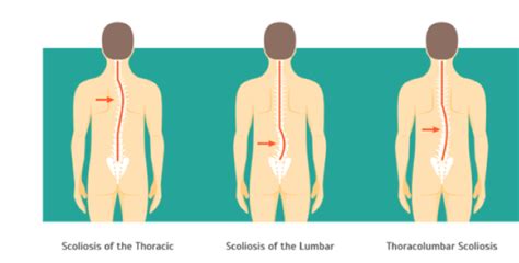 Scoliosis Treatment Symptoms Causes And Diagnosis Qi Spine