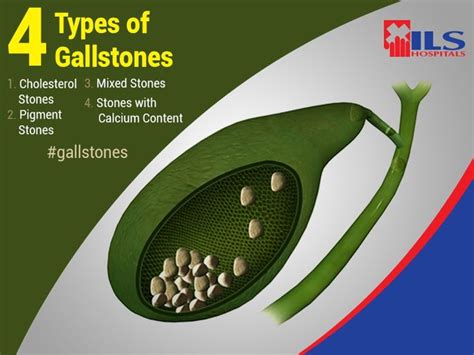 Did You Know That There 4 Different Types Of ‪‎gallstones‬ Here Is