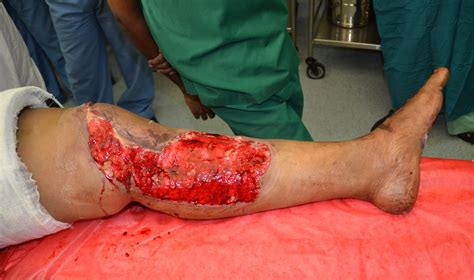 DEGLOVING INJURY LEFT LEG AND KNEE - ROLE OF NEGATIVE PRESSURE WOUND ...