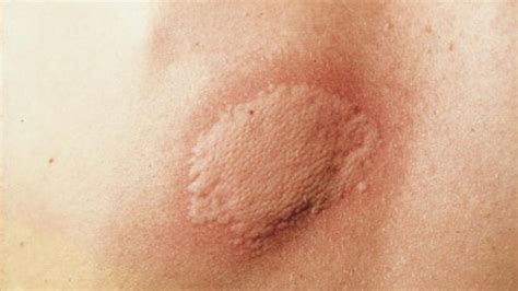 Hives Skin Rash Treatment Causes Symptoms