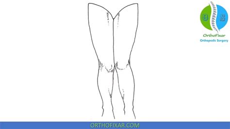 Knee Q Angle Measurement Orthofixar 2024