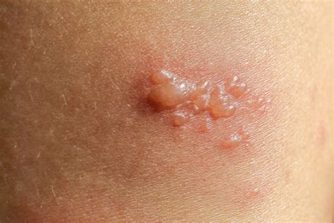 The Most Common Types Of Skin Lesions Facty Health