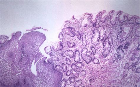 Section From Gastro Esophageal Junction Showing Be With Goblet Cells