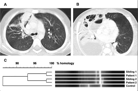 Staphyle = bunch of grapes; Transmission of Panton-Valentine Leukocidin-Positive ...