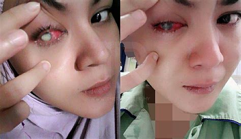 Maybe you would like to learn more about one of these? Punca Mata Merah Sebelah Kiri - Selalu sakit pada sebelah ...