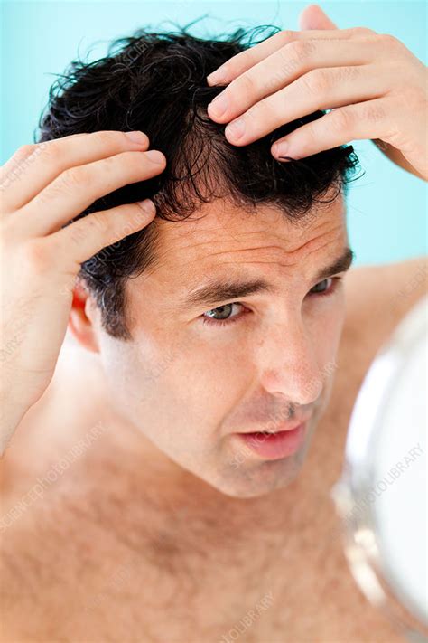 Male Hair Loss Stock Image C0325679 Science Photo Library