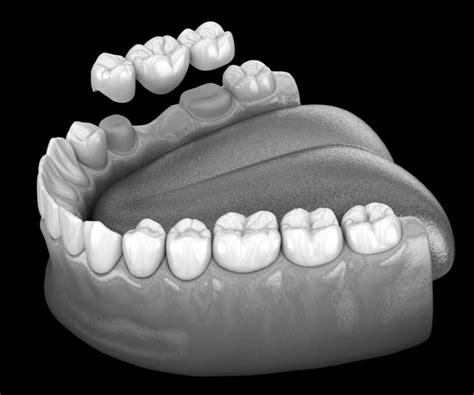 types of dental bridges and how they differ from implants shields dental clinic