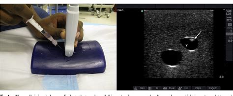Needle Tip Visualization During Ultrasound Guided Vascular Access