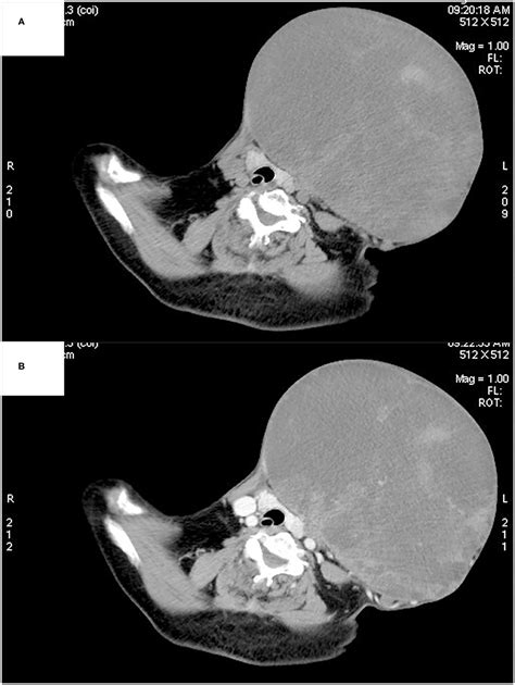 Frontiers Surgical Treatment Of A Giant Pleomorphic Adenoma Of The