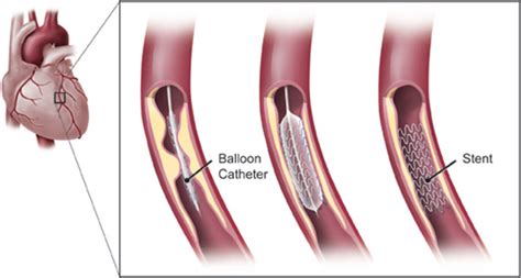 Coronary Angioplasty And Stenting Lim Ing Haan Cardiology Clinic